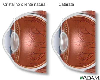 paquimetria