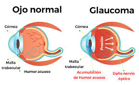 glaucoma